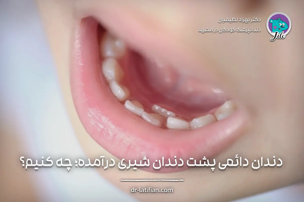 رویش دندان دائمی پشت دندان شیری یا دندان کوسه‌ای و بررسی زمان مراجعه به دندانپزشک
