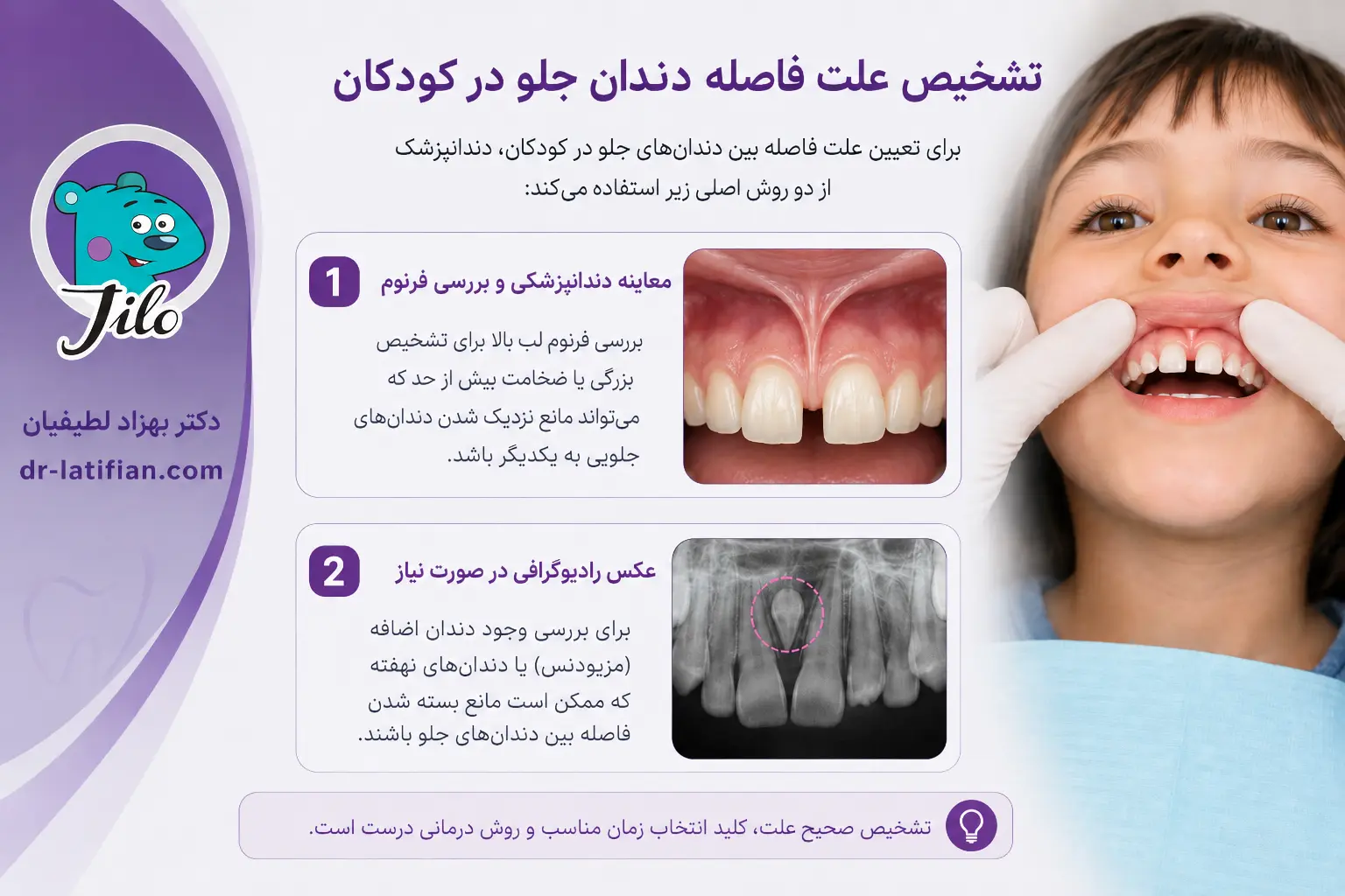 تشخیص علت فاصله بین دندان‌های جلوی کودکان با معاینه فرنوم لب و رادیوگرافی در صورت نیاز
