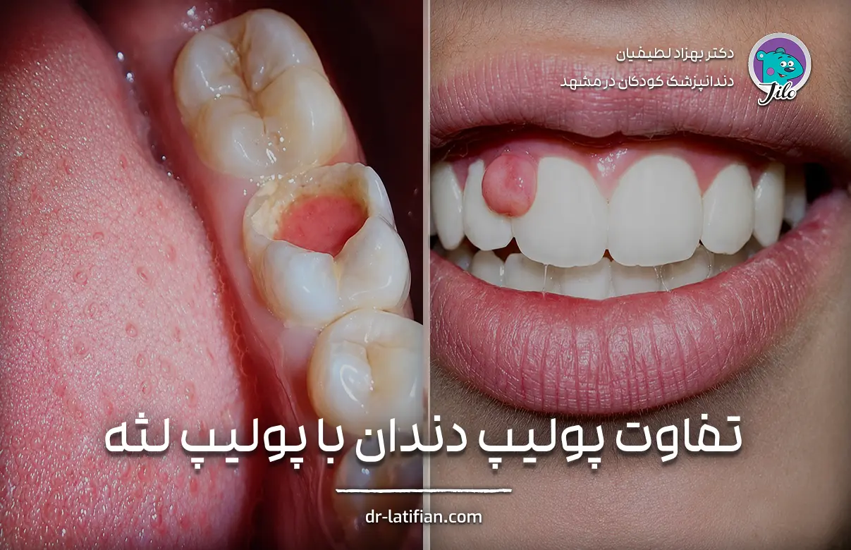 تفاوت پولیپ دندان و پولیپ لثه از نظر منشأ توده، محل اتصال و ارتباط با پالپ یا بافت لثه