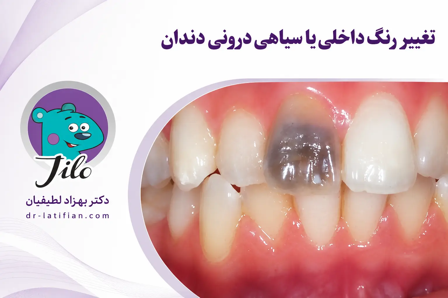 تغییر رنگ داخلی دندان