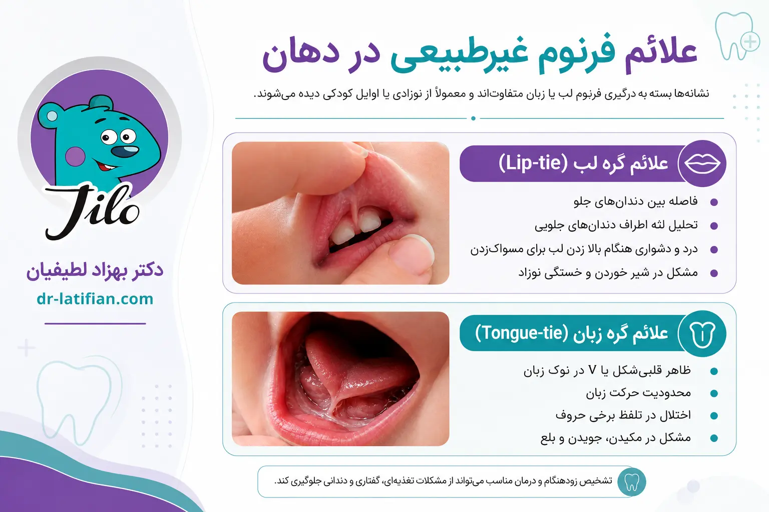 علائم فرنوم غیرطبیعی در دهان شامل نشانه‌های گره لب و گره زبان