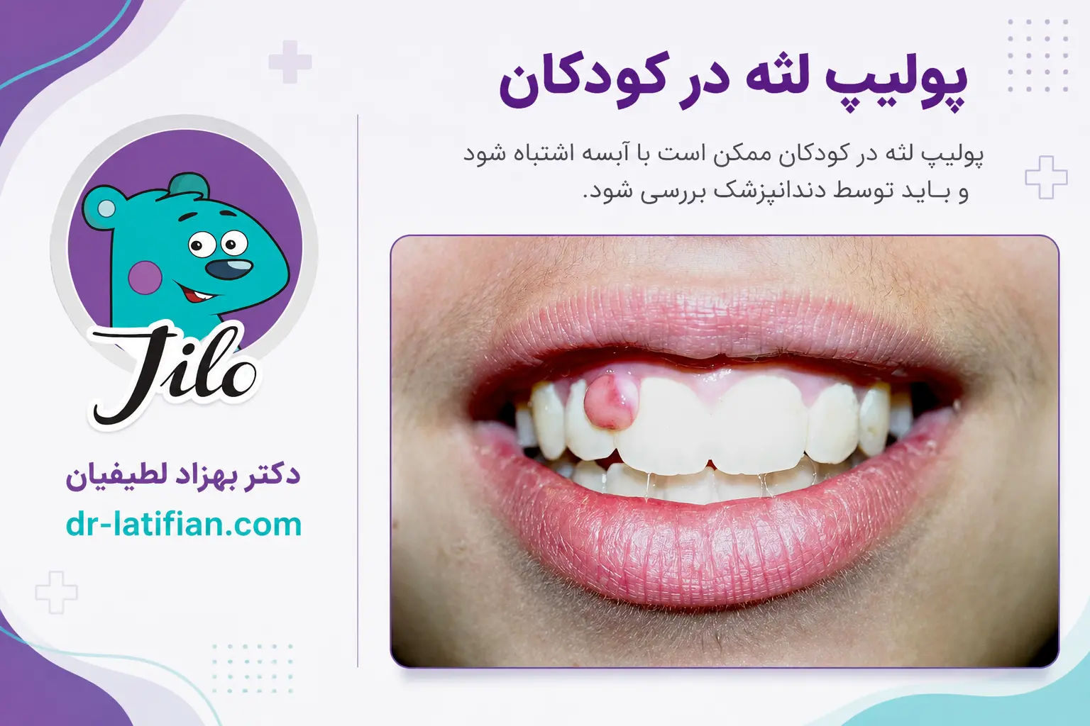 پولیپ لثه در کودک و زائده گوشتی روی لثه