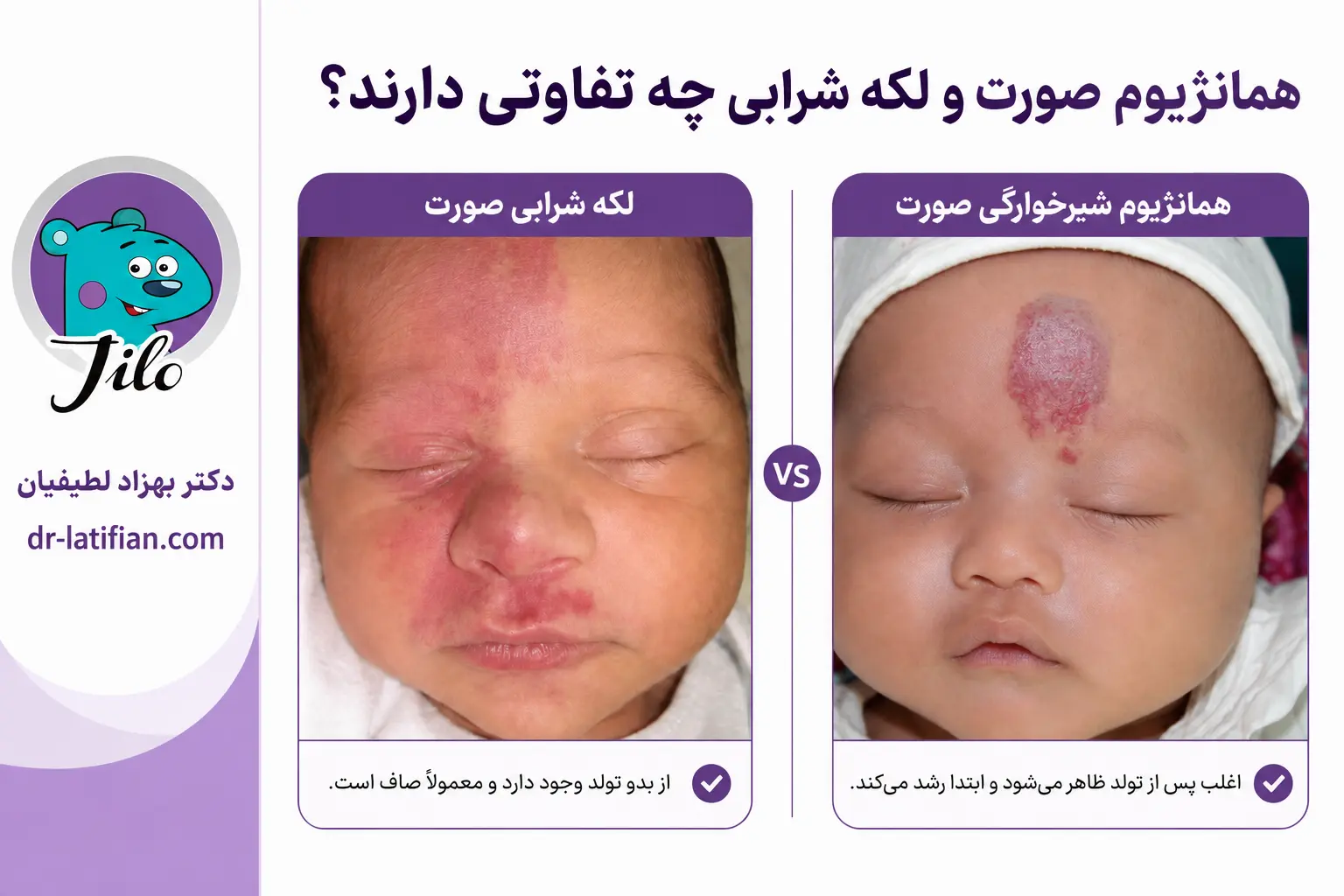 مقایسه همانژیوم شیرخوارگی صورت با لکه شرابی در نوزاد