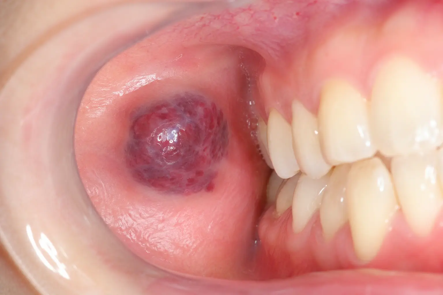 همانژیوم دهان و صورت و ارتباط آن با ماه‌گرفتگی، شامل ضایعات عروقی روی صورت، لب و داخل دهان