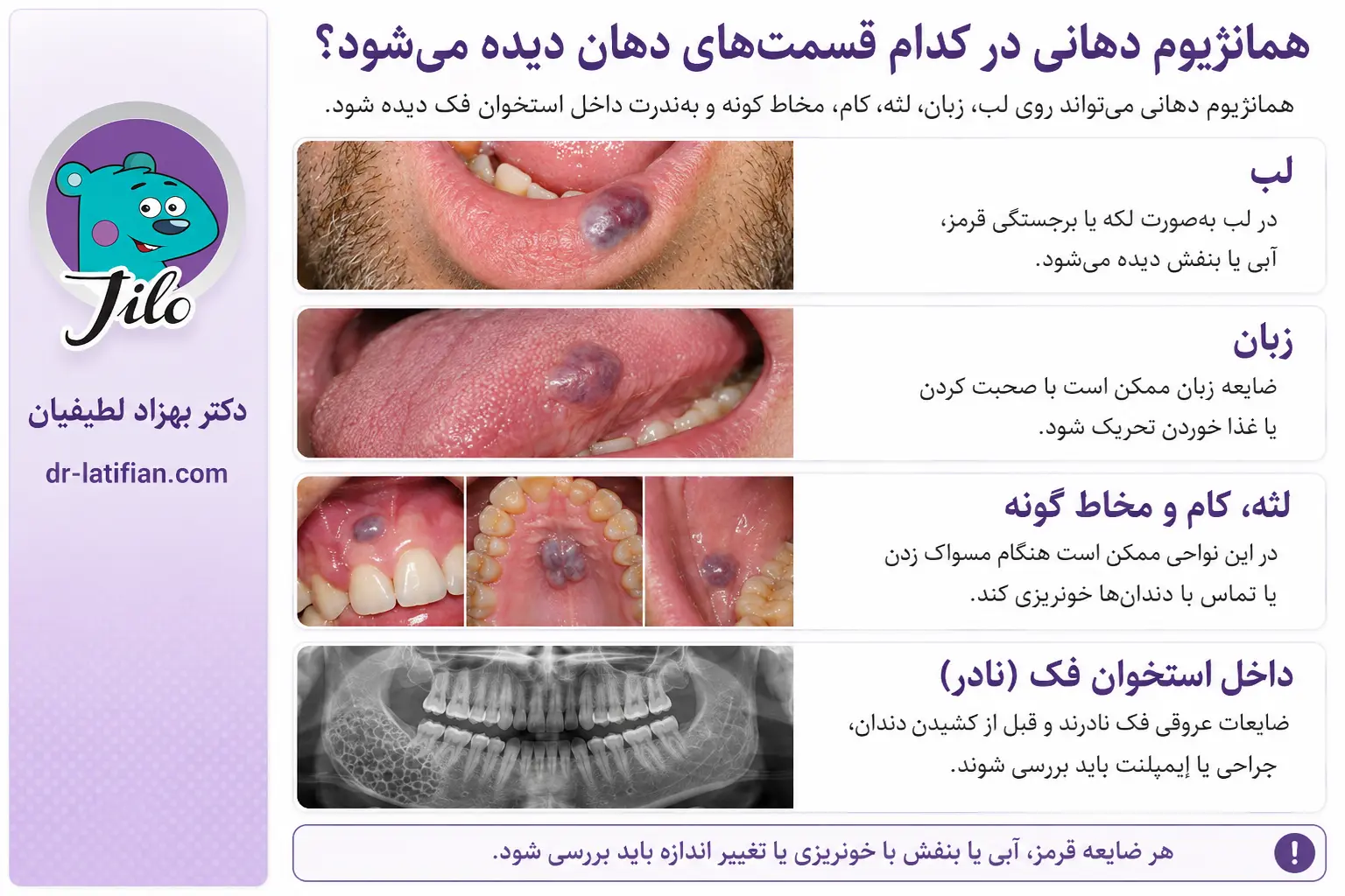 همانژیوم دهانی در لب، زبان، لثه، مخاط دهان و گاهی داخل استخوان فک دیده می‌شود و ممکن است خونریزی‌پذیر باشد
