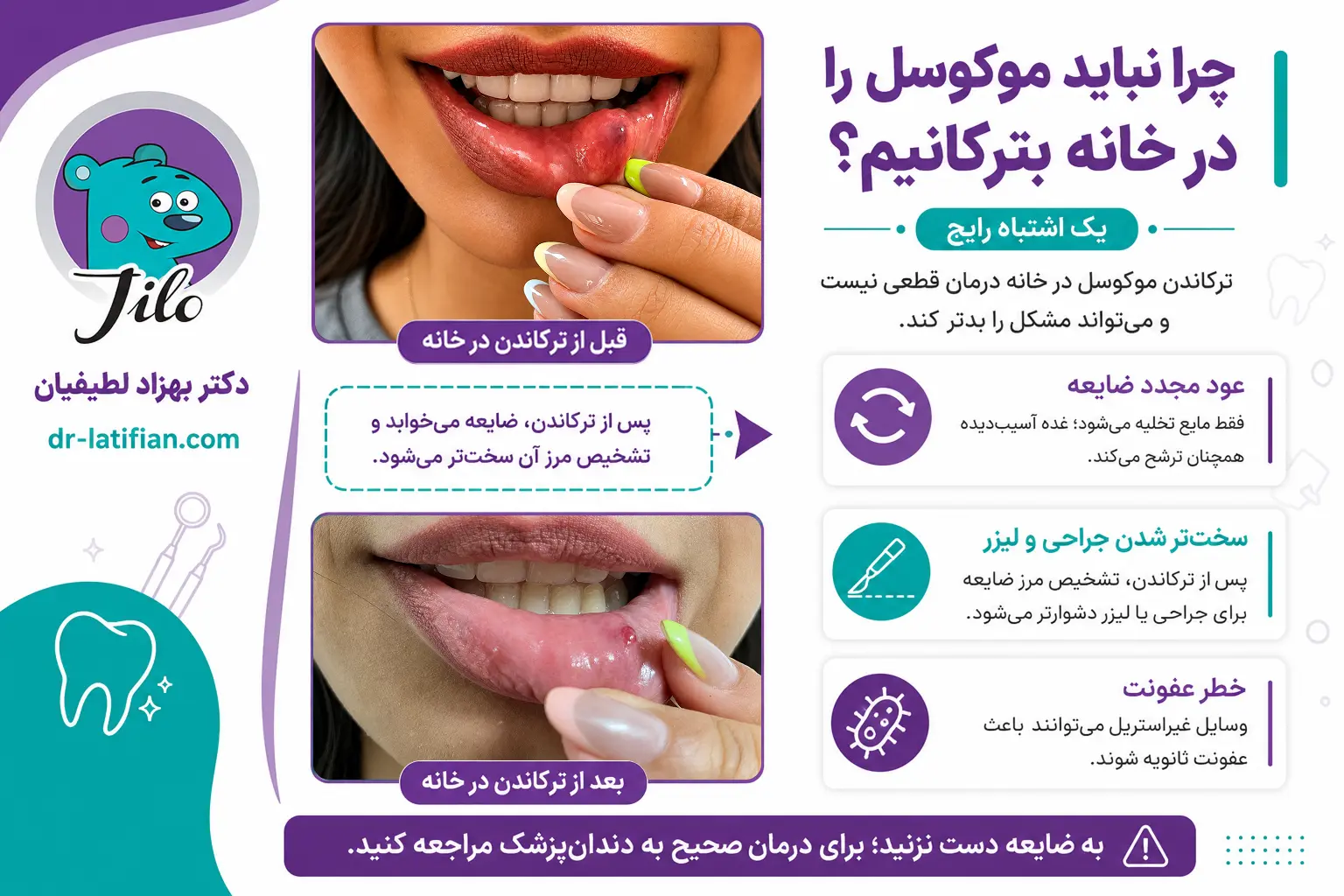 خطر ترکاندن موکوسل در خانه شامل عود ضایعه، سخت‌تر شدن درمان و عفونت